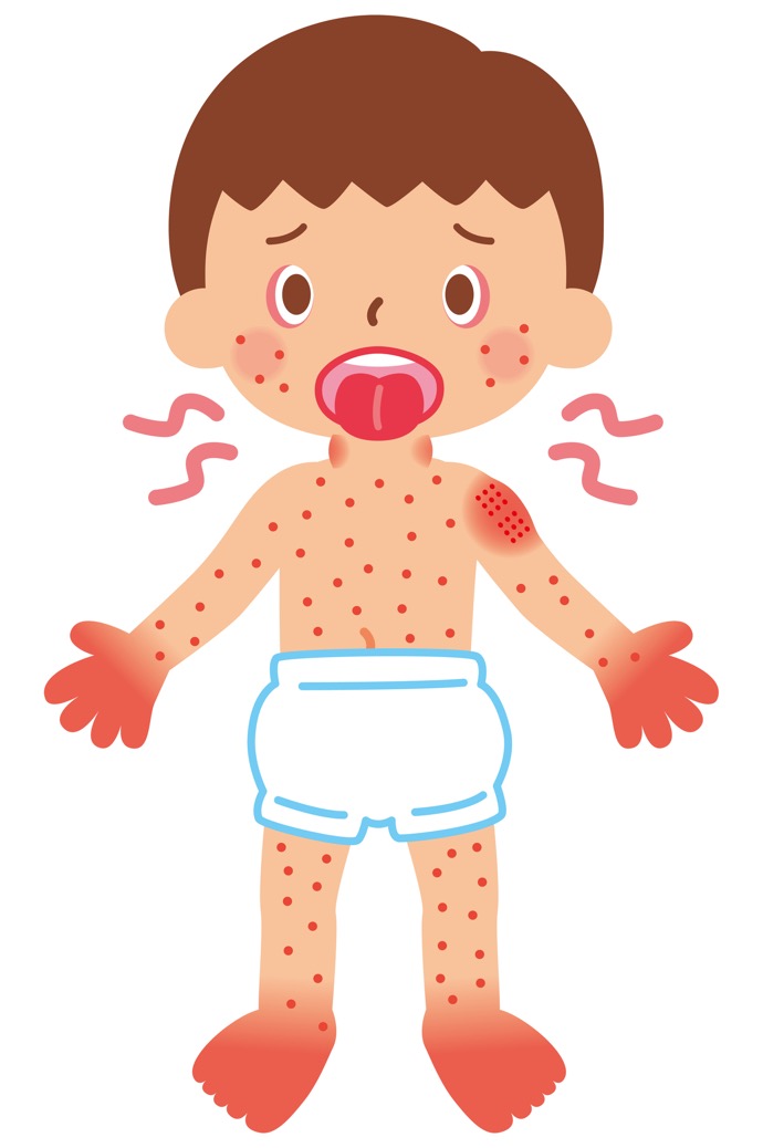 子どもの、のどの痛みの原因に!「溶連菌」とその感染症とは?